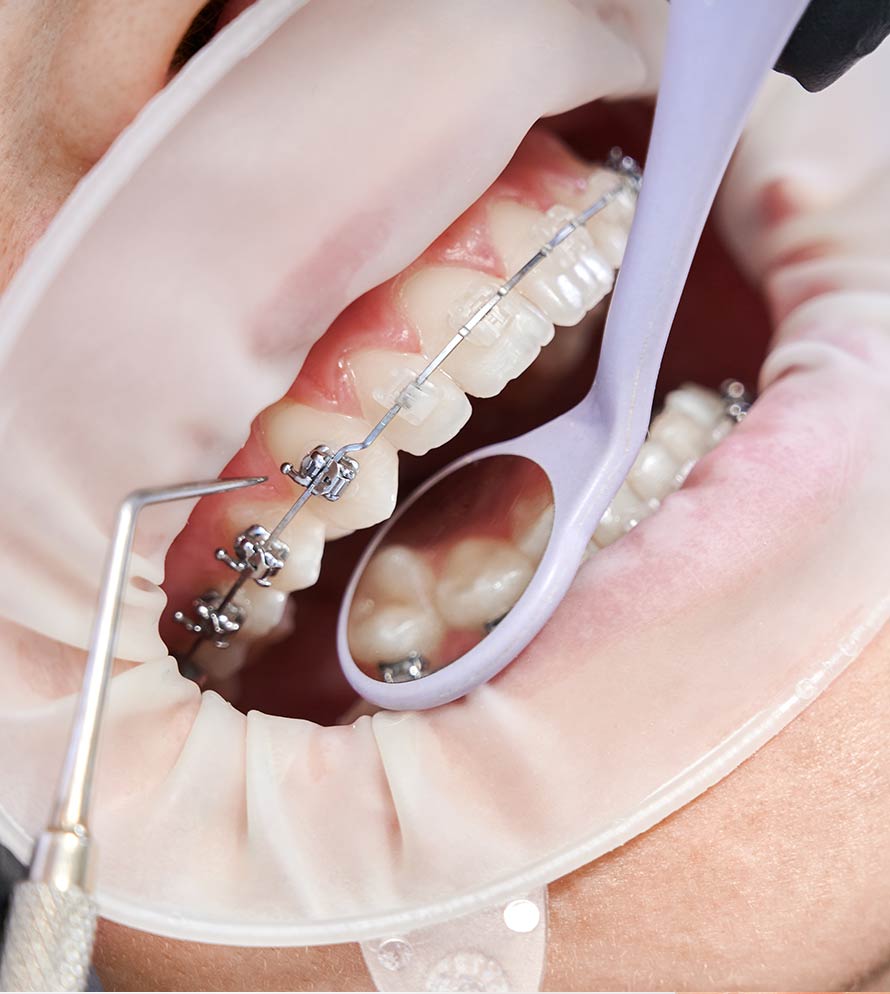 Ortodoncia funcional y brackets